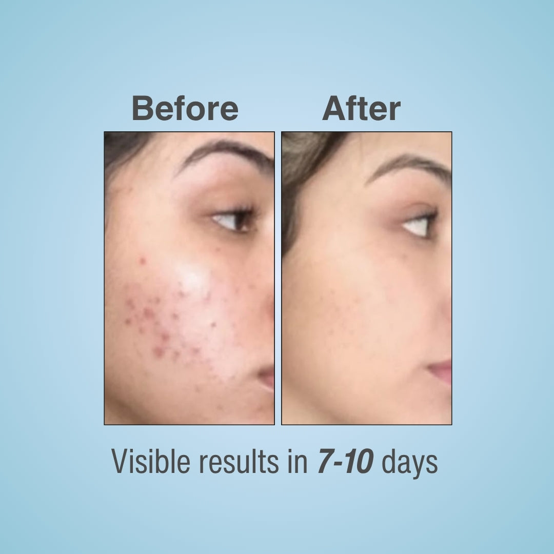Pureclans Acne Correcting Serum Before & After